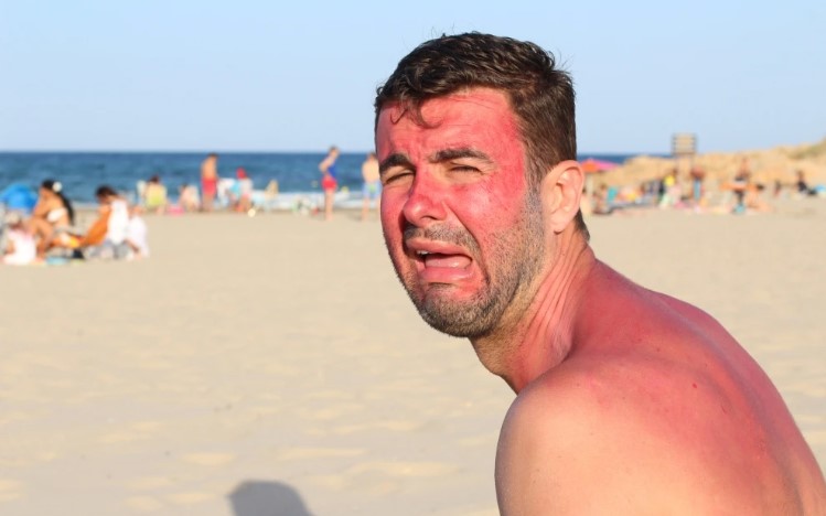 去海邊曬傷怎麼辦?擦蘆薈真的有用嗎?5個「曬傷後療法」步驟介紹